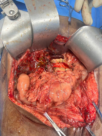 Post Whipples resection for CCP