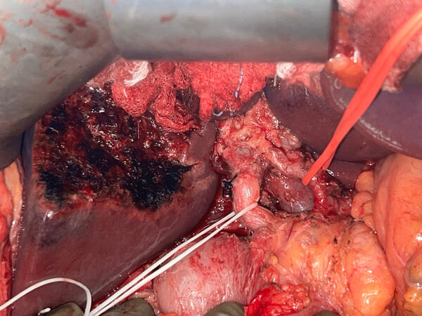 Radical cholecystectomy for CA GB