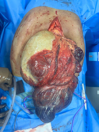 Giant GIST of stomach
