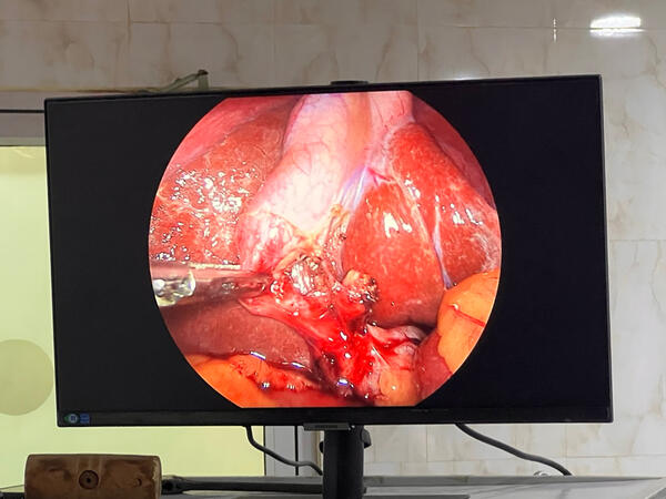 Critical view of safety in lap cholecystectomy Critical view of safety in lap cholecystectomy