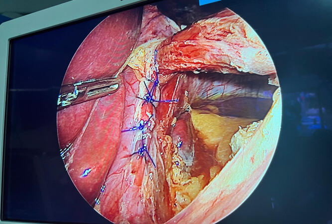 Crural repair in fundoplication
