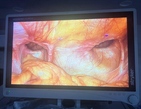 Laparoscopic view of bilateral inguinal hernia