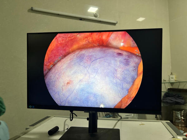 Large benign ovarian cyst removed laparoscopically