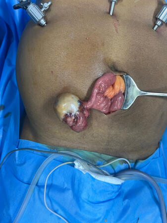 Lab assisted excision of small bowel GIST