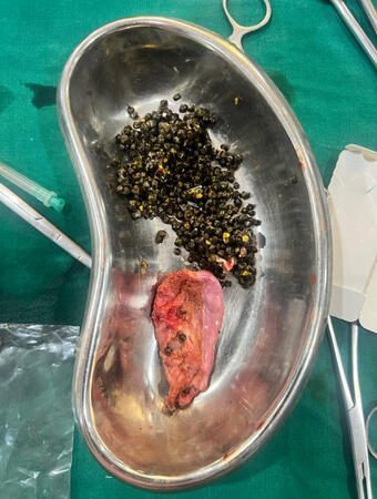 Hundreds of gallstones