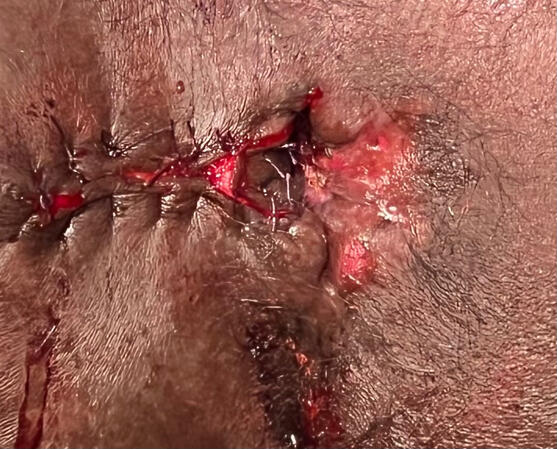 Anoplasty for post hemorrhoidectomy anal stricture Anoplasty for post hemorrhoidectomy anal stricture