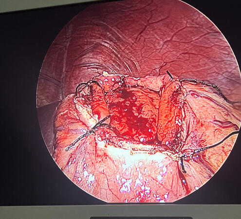 Lap cystogastrostomy in process.. Lap cystogastrostomy in process..